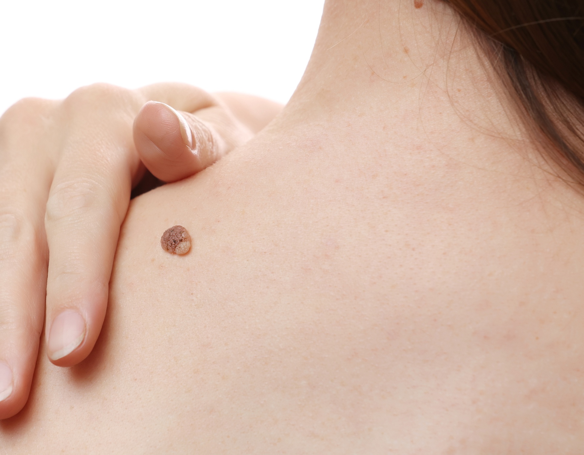 Grand grain de beaute sur le dos d une femme cancer de la peau | Dr Barbera Paris