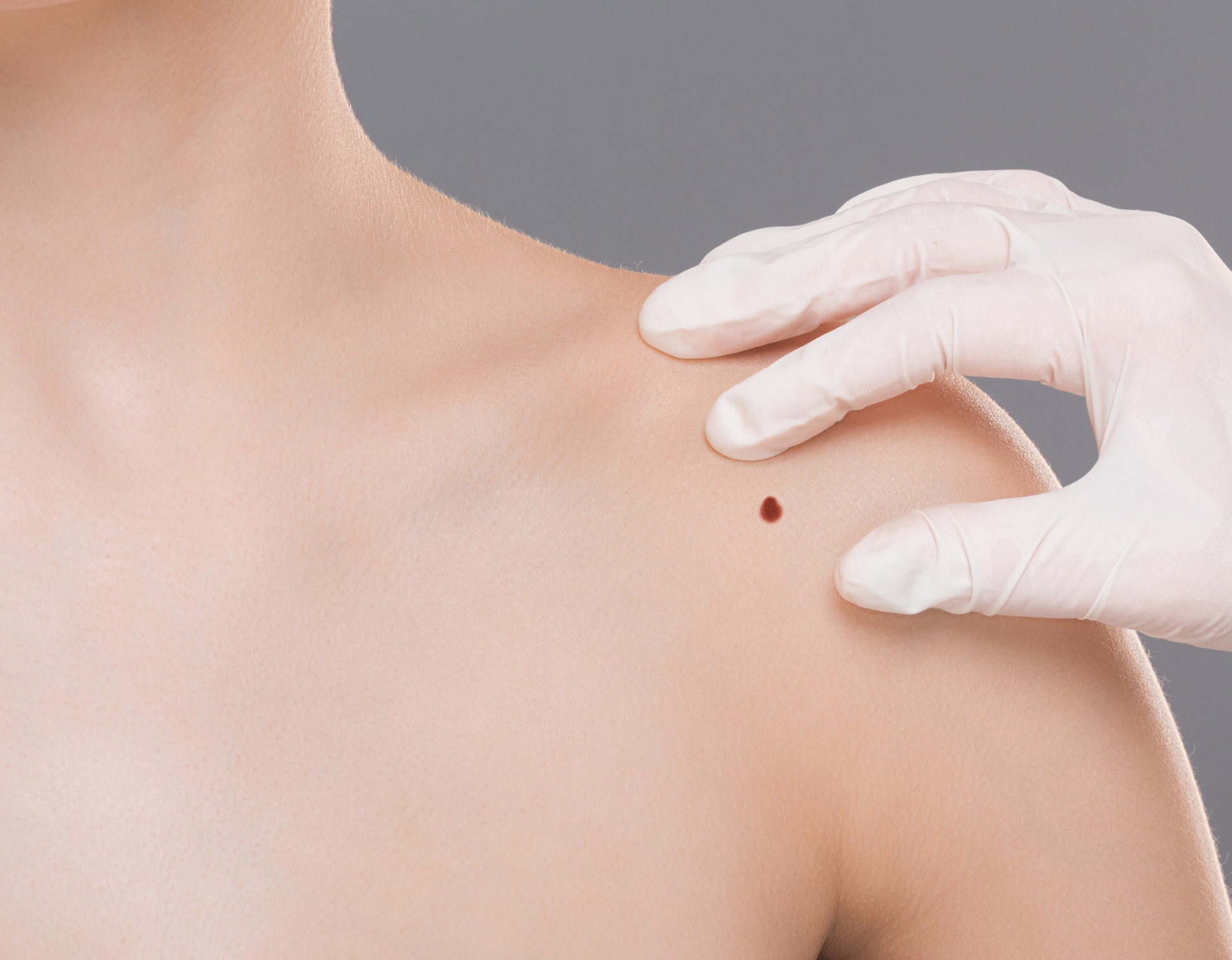 Grain de beaute sur l epaule d une jeune femme chirurgie dermatologique | Dr Barbera Paris