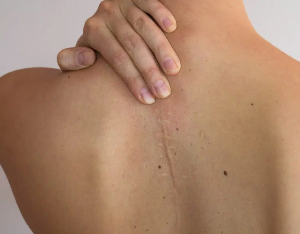 Partie du dos d une femme montrant une grande cicatrice chirurgie des cicatrices | Dr Barbera Paris