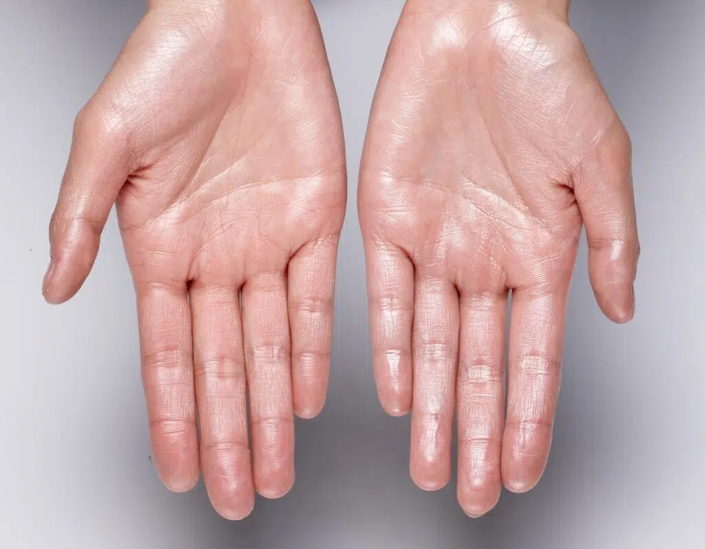 Photo montrant les deux pomme des mains d une femme Hyperhidrose | Dr Barbera Paris