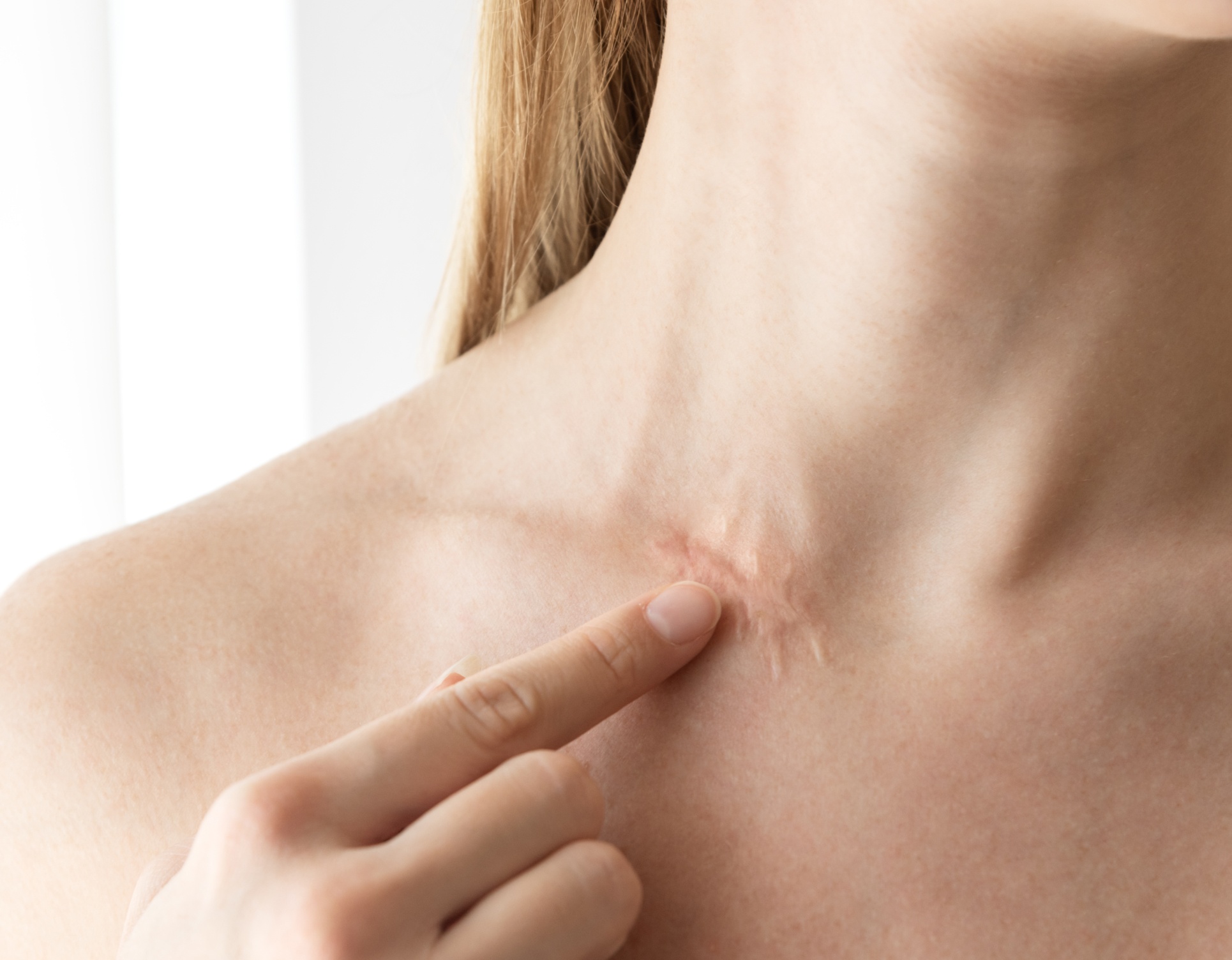 Laser Urgo Touch | Chirurgie dermatologique | Dr Barbera | Paris 16