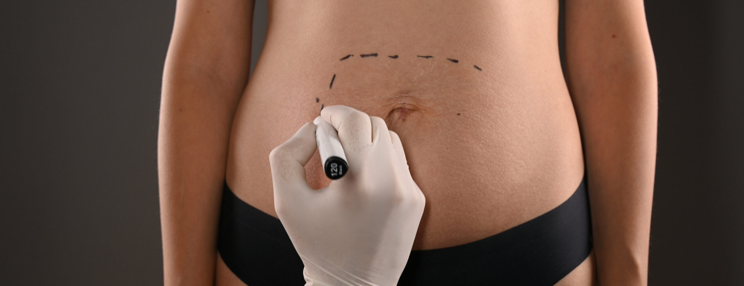 Abdominoplastie | Dr Barbera | Paris 16