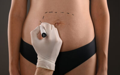 Abdominoplastie | Dr Barbera | Paris 16