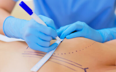 Asymétrie mammaire | Dr Barbera | Paris 16